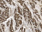 IHC staining of FFPE human colonic adenocarcinoma tissue with Vesicle-fusing ATPase antibody. HIER: boil tissue sections in pH8 EDTA for 20 min and allow to cool before testing.