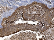 IHC staining of FFPE human lung cancer with Vesicle-fusing ATPase antibody. HIER: boil tissue sections in pH8 EDTA for 20 min and allow to cool before testing.