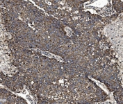 IHC staining of FFPE human liver cancer tissue with Vesicle-fusing ATPase antibody. HIER: boil tissue sections in pH8 EDTA for 20 min and allow to cool before testing.