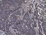 IHC staining of FFPE human gallbladder adenocarcinoma tissue with Vesicle-fusing ATPase antibody. HIER: boil tissue sections in pH8 EDTA for 20 min and allow to cool before testing.