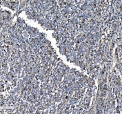 IHC staining of FFPE human lymphoma tissue with PDI antibody. HIER: boil tissue sections in pH8 EDTA for 20 min and allow to cool before testing.