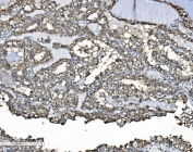 IHC staining of FFPE human renal clear cell carcinoma tissue with PDI antibody. HIER: boil tissue sections in pH8 EDTA for 20 min and allow to cool before testing.