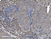 IHC staining of FFPE human lung cancer tissue with PDI antibody. HIER: boil tissue sections in pH8 EDTA for 20 min and allow to cool before testing.
