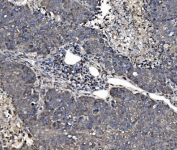 IHC staining of FFPE human liver cancer tissue with PDI antibody. HIER: boil tissue sections in pH8 EDTA for 20 min and allow to cool before testing.