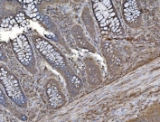 IHC staining of FFPE human rectal cancer tissue with INPPL1 antibody. HIER: boil tissue sections in pH8 EDTA for 20 min and allow to cool before testing.