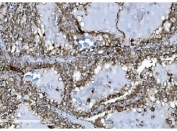 IHC staining of FFPE human renal clear cell carcinoma tissue with INPPL1 antibody. HIER: boil tissue sections in pH8 EDTA for 20 min and allow to cool before testing.