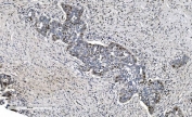 IHC staining of FFPE human ovarian serous adenocarcinoma tissue with MCM6 antibody. HIER: boil tissue sections in pH8 EDTA for 20 min and allow to cool before testing.