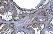 IHC staining of FFPE human ovarian adenocarcinoma tissue with MCM6 antibody. HIER: boil tissue sections in pH8 EDTA for 20 min and allow to cool before testing.