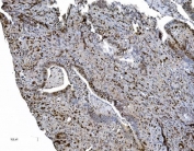 IHC staining of FFPE human gallbladder adenocarcinoma tissue with MCM6 antibody. HIER: boil tissue sections in pH8 EDTA for 20 min and allow to cool before testing.