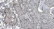 IHC staining of FFPE human breast cancer tissue with MCM6 antibody. HIER: boil tissue sections in pH8 EDTA for 20 min and allow to cool before testing.