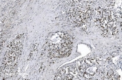 IHC staining of FFPE human gastric adenocarcinoma tissue with MCM6 antibody. HIER: boil tissue sections in pH8 EDTA for 20 min and allow to cool before testing.