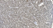IHC staining of FFPE human adrenocortical adenoma tissue with CBX5 antibody. HIER: boil tissue sections in pH8 EDTA for 20 min and allow to cool before testing.