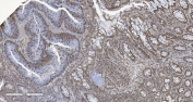 IHC staining of FFPE human rectal cancer tissue with CBX5 antibody. HIER: boil tissue sections in pH8 EDTA for 20 min and allow to cool before testing.