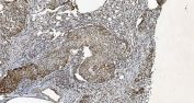 IHC staining of FFPE human breast cancer tissue with CBX5 antibody. HIER: boil tissue sections in pH8 EDTA for 20 min and allow to cool before testing.IHC staining of FFPE human gallbladder adenocarcinoma tissue with CBX5 antibody. HIER: boil tissue sections in pH8 EDTA for 20 min and allow to cool before testing.