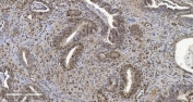 IHC staining of FFPE human gallbladder adenocarcinoma tissue with CBX5 antibody. HIER: boil tissue sections in pH8 EDTA for 20 min and allow to cool before testing.