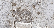 IHC staining of FFPE human ovarian serous adenocarcinoma tissue with CBX5 antibody. HIER: boil tissue sections in pH8 EDTA for 20 min and allow to cool before testing.