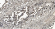 IHC staining of FFPE human renal clear cell carcinoma tissue with CBX5 antibody. HIER: boil tissue sections in pH8 EDTA for 20 min and allow to cool before testing.