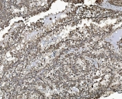 IHC staining of FFPE human renal clear cell carcinoma tissue with Prohibitin 2 antibody. HIER: boil tissue sections in pH8 EDTA for 20 min and allow to cool before testing.