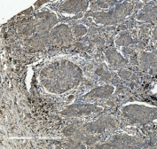 IHC staining of FFPE human lung cancer tissue with ITGB5 antibody. HIER: boil tissue sections in pH8 EDTA for 20 min and allow to cool before testing.