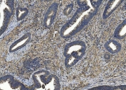 IHC staining of FFPE human rectal cancer tissue with ITGB5 antibody. HIER: boil tissue sections in pH8 EDTA for 20 min and allow to cool before testing.