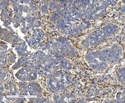 IHC staining of FFPE human ovarian serous adenocarcinoma tissue with ITGB5 antibody. HIER: boil tissue sections in pH8 EDTA for 20 min and allow to cool before testing.