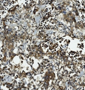IHC staining of FFPE human gastric cancer with Caspase-5 antibody. HIER: boil tissue sections in pH8 EDTA for 20 min and allow to cool before testing.