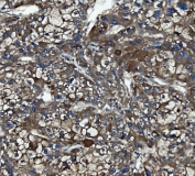 IHC staining of FFPE human liver cancer with Caspase-5 antibody. HIER: boil tissue sections in pH8 EDTA for 20 min and allow to cool before testing.