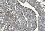 IHC staining of FFPE human lung cancer with Caspase-9 antibody. HIER: boil tissue sections in pH8 EDTA for 20 min and allow to cool before testing.