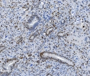 IHC staining of FFPE human gallbladder adenocarcinoma tissue with SAMHD1 antibody. HIER: boil tissue sections in pH8 EDTA for 20 min and allow to cool before testing.