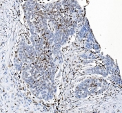 IHC staining of FFPE human ovarian serous adenocarcinoma tissue with SAMHD1 antibody. HIER: boil tissue sections in pH8 EDTA for 20 min and allow to cool before testing.