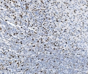 IHC staining of FFPE human lymphoma tissue with SAMHD1 antibody. HIER: boil tissue sections in pH8 EDTA for 20 min and allow to cool before testing.