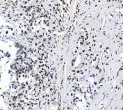 IHC staining of FFPE human gastric adenocarcinoma tissue with SAMHD1 antibody. HIER: boil tissue sections in pH8 EDTA for 20 min and allow to cool before testing.