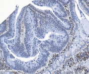 IHC staining of FFPE human rectal cancer tissue with SAMHD1 antibody. HIER: boil tissue sections in pH8 EDTA for 20 min and allow to cool before testing.