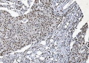IHC staining of FFPE human breast cancer tissue with SAMHD1 antibody. HIER: boil tissue sections in pH8 EDTA for 20 min and allow to cool before testing.