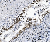 IHC staining of FFPE human lung cancer tissue with SAMHD1 antibody. HIER: boil tissue sections in pH8 EDTA for 20 min and allow to cool before testing.