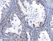 IHC staining of FFPE human ovarian cancer tissue with SAMHD1 antibody. HIER: boil tissue sections in pH8 EDTA for 20 min and allow to cool before testing.