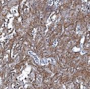 IHC staining of FFPE human lung cancer with EHD3 antibody. HIER: boil tissue sections in pH8 EDTA for 20 min and allow to cool before testing.