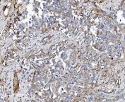 IHC staining of FFPE human gastric adenocarcinoma tissue with EHD3 antibody. HIER: boil tissue sections in pH8 EDTA for 20 min and allow to cool before testing.