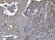 IHC staining of FFPE human breast cancer tissue with EHD3 antibody. HIER: boil tissue sections in pH8 EDTA for 20 min and allow to cool before testing.