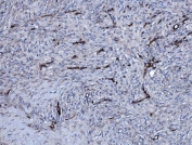 IHC staining of FFPE human ovarian serous adenocarcinoma tissue with EHD3 antibody. HIER: boil tissue sections in pH8 EDTA for 20 min and allow to cool before testing.