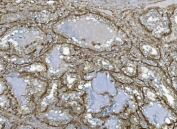 IHC staining of FFPE human renal clear cell carcinoma tissue with EHD3 antibody. HIER: boil tissue sections in pH8 EDTA for 20 min and allow to cool before testing.