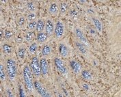 IHC staining of FFPE human rectal cancer tissue with EHD3 antibody. HIER: boil tissue sections in pH8 EDTA for 20 min and allow to cool before testing.