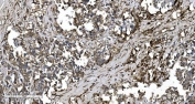 IHC staining of FFPE human gastric adenocarcinoma tissue with EPRS antibody. HIER: boil tissue sections in pH8 EDTA for 20 min and allow to cool before testing.