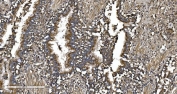 IHC staining of FFPE human lung cancer tissue with EPRS antibody. HIER: boil tissue sections in pH8 EDTA for 20 min and allow to cool before testing.
