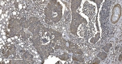 IHC staining of FFPE human breast cancer tissue with EPRS antibody. HIER: boil tissue sections in pH8 EDTA for 20 min and allow to cool before testing.