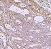 IHC staining of FFPE human rectal cancer tissue with Interferon regulatory factor 3 antibody. HIER: boil tissue sections in pH8 EDTA for 20 min and allow to cool before testing.