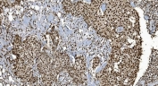 IHC staining of FFPE human breast cancer tissue with Ku70 antibody. HIER: boil tissue sections in pH8 EDTA for 20 min and allow to cool before testing.