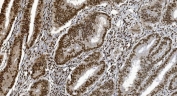 IHC staining of FFPE human rectal cancer tissue with Ku70 antibody. HIER: boil tissue sections in pH8 EDTA for 20 min and allow to cool before testing.