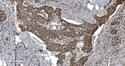 IHC staining of FFPE human ovarian serous adenocarcinoma tissue with Ku70/XRCC6 antibody. HIER: boil tissue sections in pH8 EDTA for 20 min and allow to cool before testing.