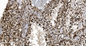 IHC staining of FFPE human renal clear cell carcinoma tissue with Ku70/XRCC6 antibody. HIER: boil tissue sections in pH8 EDTA for 20 min and allow to cool before testing.
